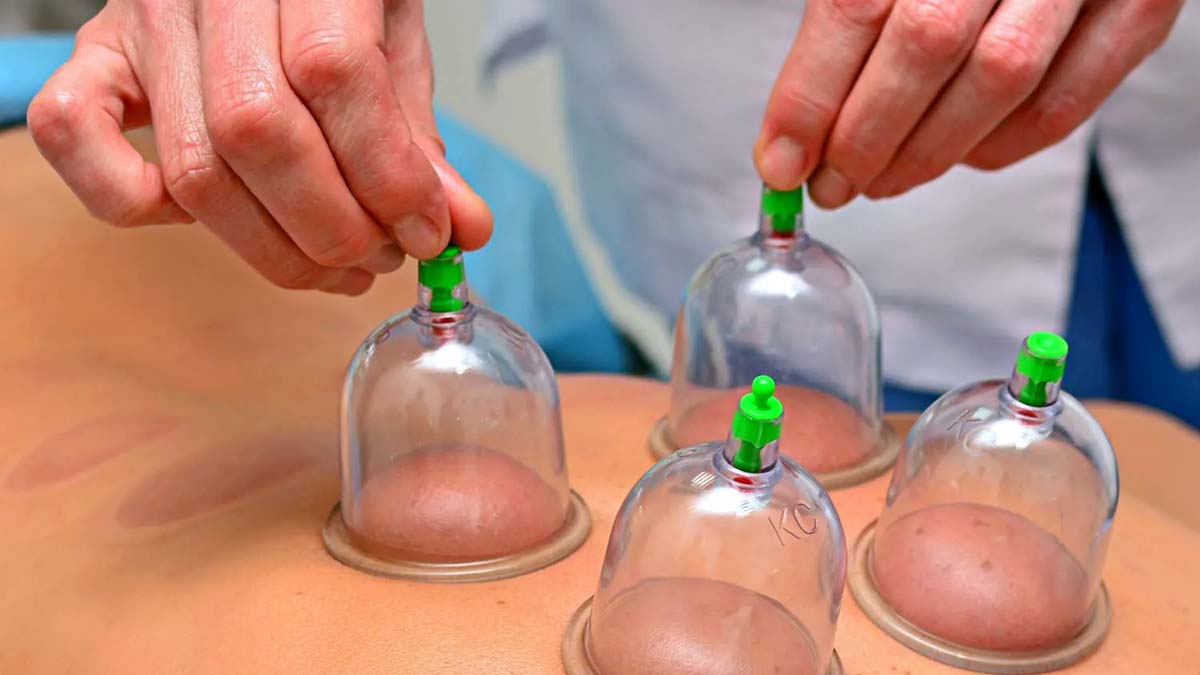 Speed Up Your Recovery Process 1 Close Up Of Physical Therapist's Hands Performing Cupping On Athelte's Back